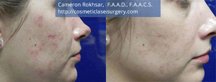 Microneedling: Before and After Treatment Photo - patient 3