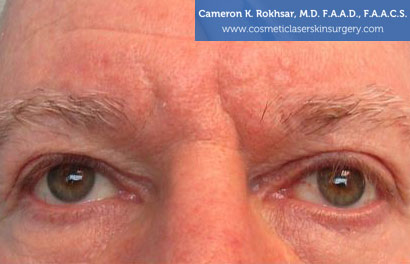 Fillers Before Treatment Photo - Patient