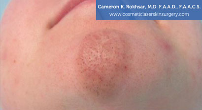 Birthmarks Before Treatment Photo - Patient