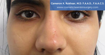 Non Surgical Nosejob After Treatment Photo - Patient