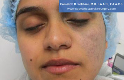 Birthmarks After Treatment Photo - Patient
