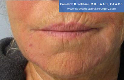 Fillers After Treatment Photo - Patient