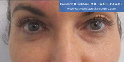 Fillers Before Treatment Photo - Patient