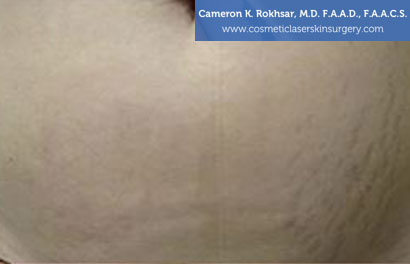 Stretch Marks Before Treatment Photo - Patient