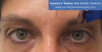 Fillers After Treatment Photo - Patient