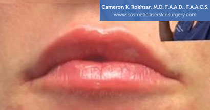 Lip Enhancement After Treatment Photo - Patient