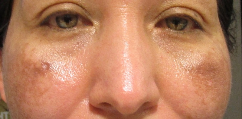 Melasma Treatment Before And After Photos • Dr Cameron Rokhsar 7756