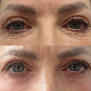 Nonsurgical Eyelid Lift - co2 laser resurfacing eyelids