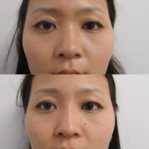 Asian Nonsurgical Nosejob