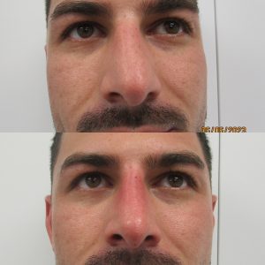 Male Nonsurgical Nose job