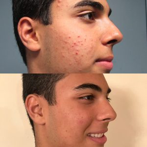 Accure patient - before and after results