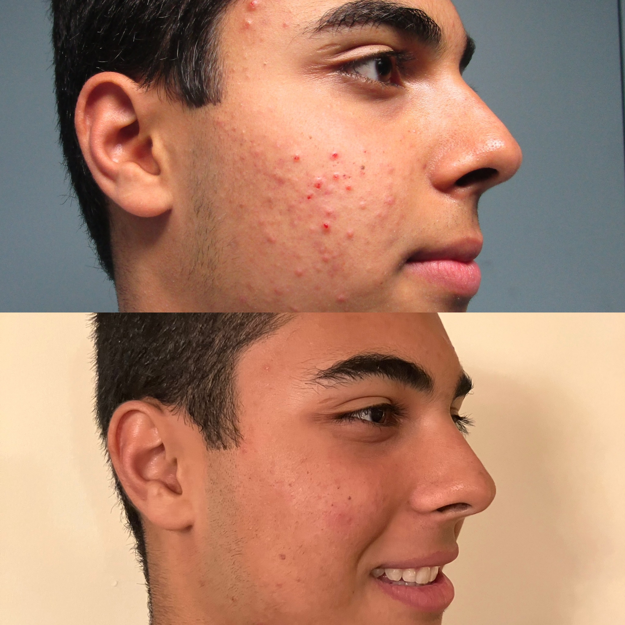 Accure Laser Before & after